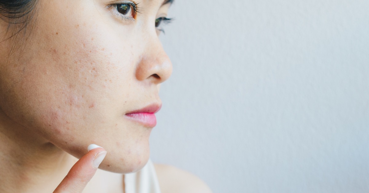 Is your acne LEGIT or is it a temporary withdrawal symptom? Dont