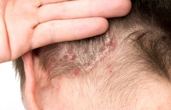 Itchy Scalp  Advanced Dermatology of the Midlands in Omaha