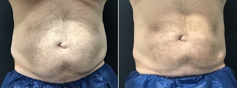 CoolSculpting - Upper & Lower Flanks Before & After Gallery - Case 4437