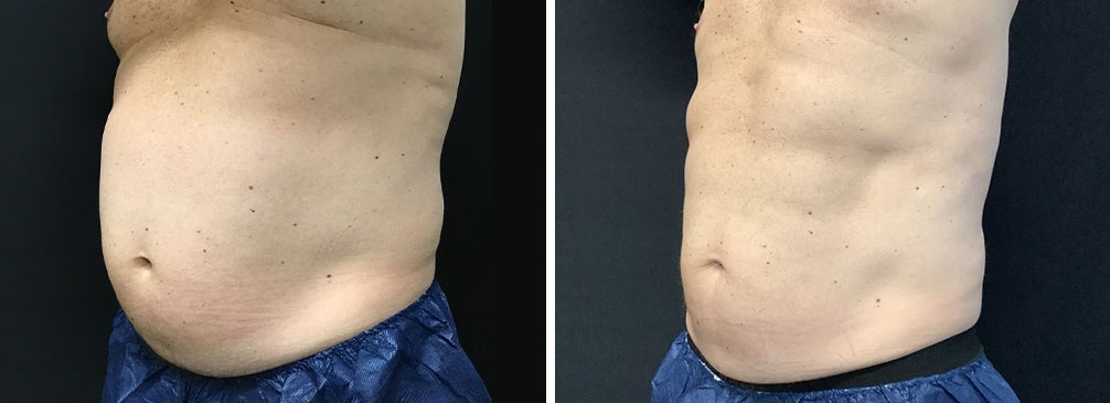 CoolSculpting Flanks (Love Handles) Before & After Photos - Cosmetic -  Ark-La-Tex Dermatology & Medical Spa - Louisiana - A Part of the  Willis-Knighton Physician Network