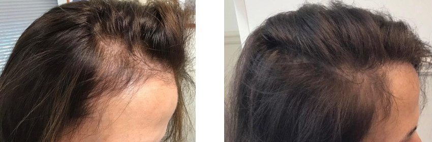 PRP for Hair Loss - Olansky Dermatology & Aesthetics