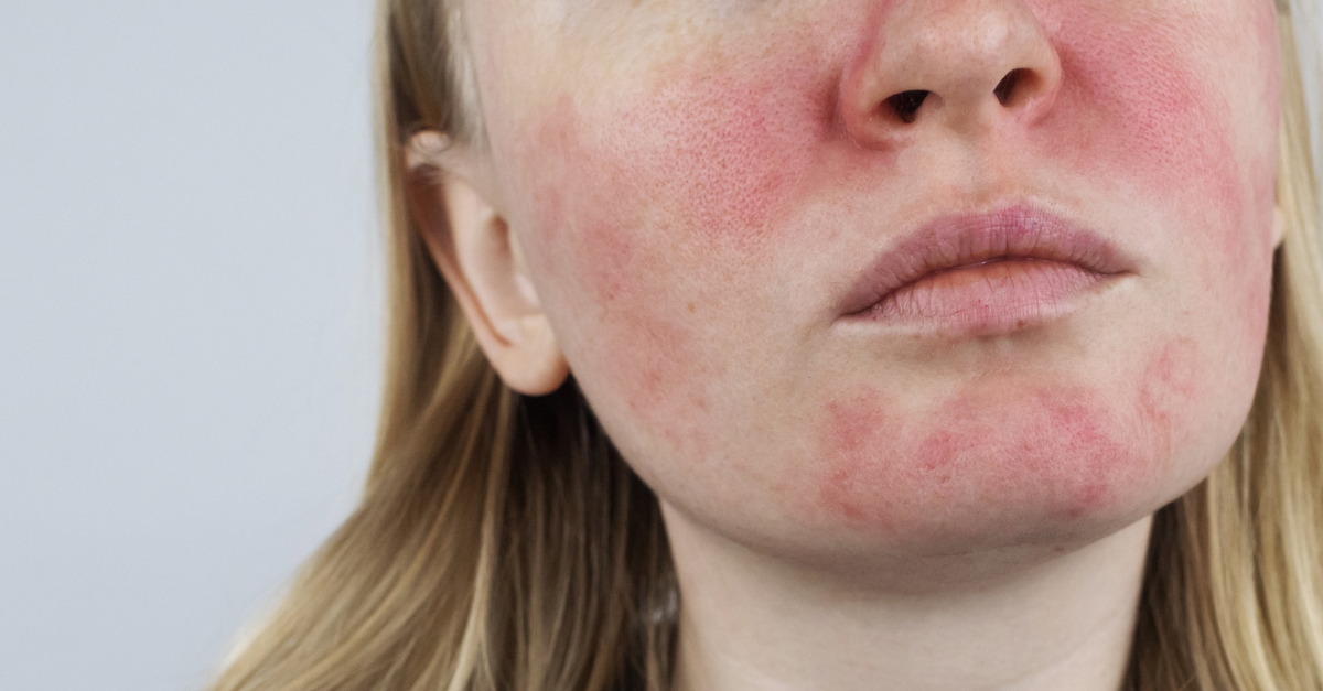 rosacea cheeks treatment