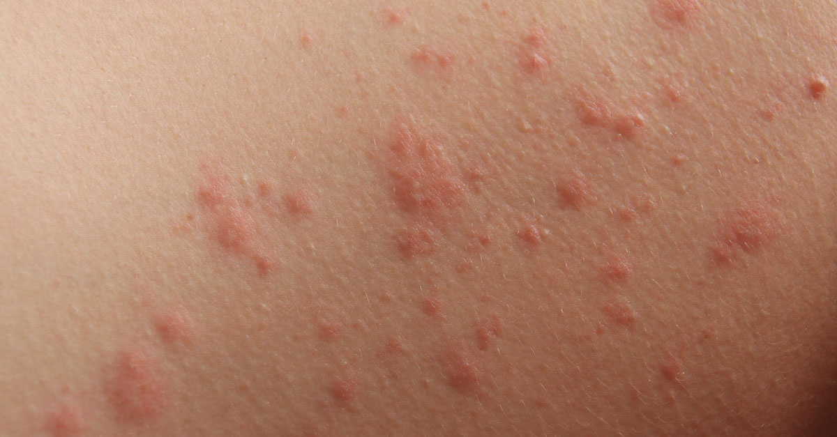 Breaking out in a rash could be a sign of CANCER - here's how tell