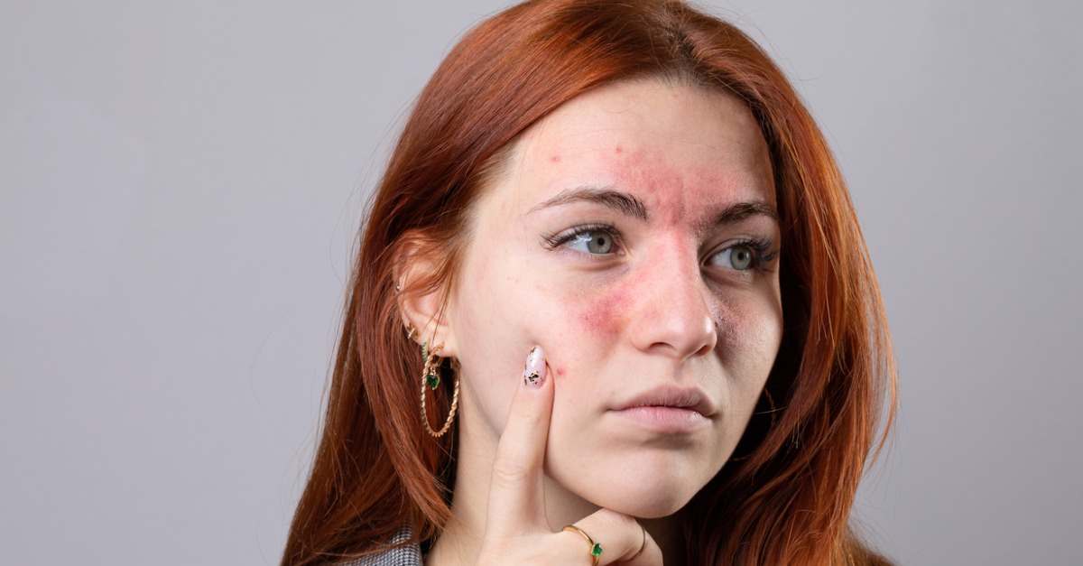 How to Manage Rosacea in the Summer - Olansky Dermatology & Aesthetics