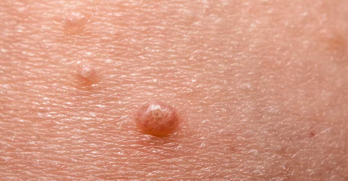 Your Guide to Molluscum Contagiosum and Treatment - Olansky Dermatology ...